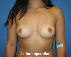 plastic-surgery-breast-augmentation